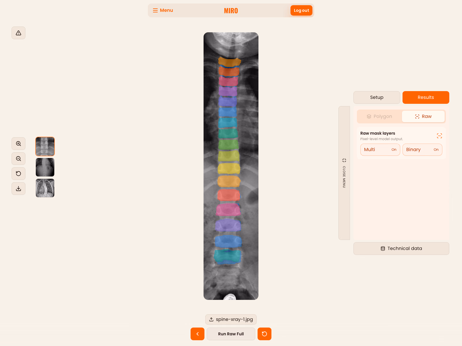 MIRO technical result view showing the raw segmentation output for the demonstration spine radiograph.