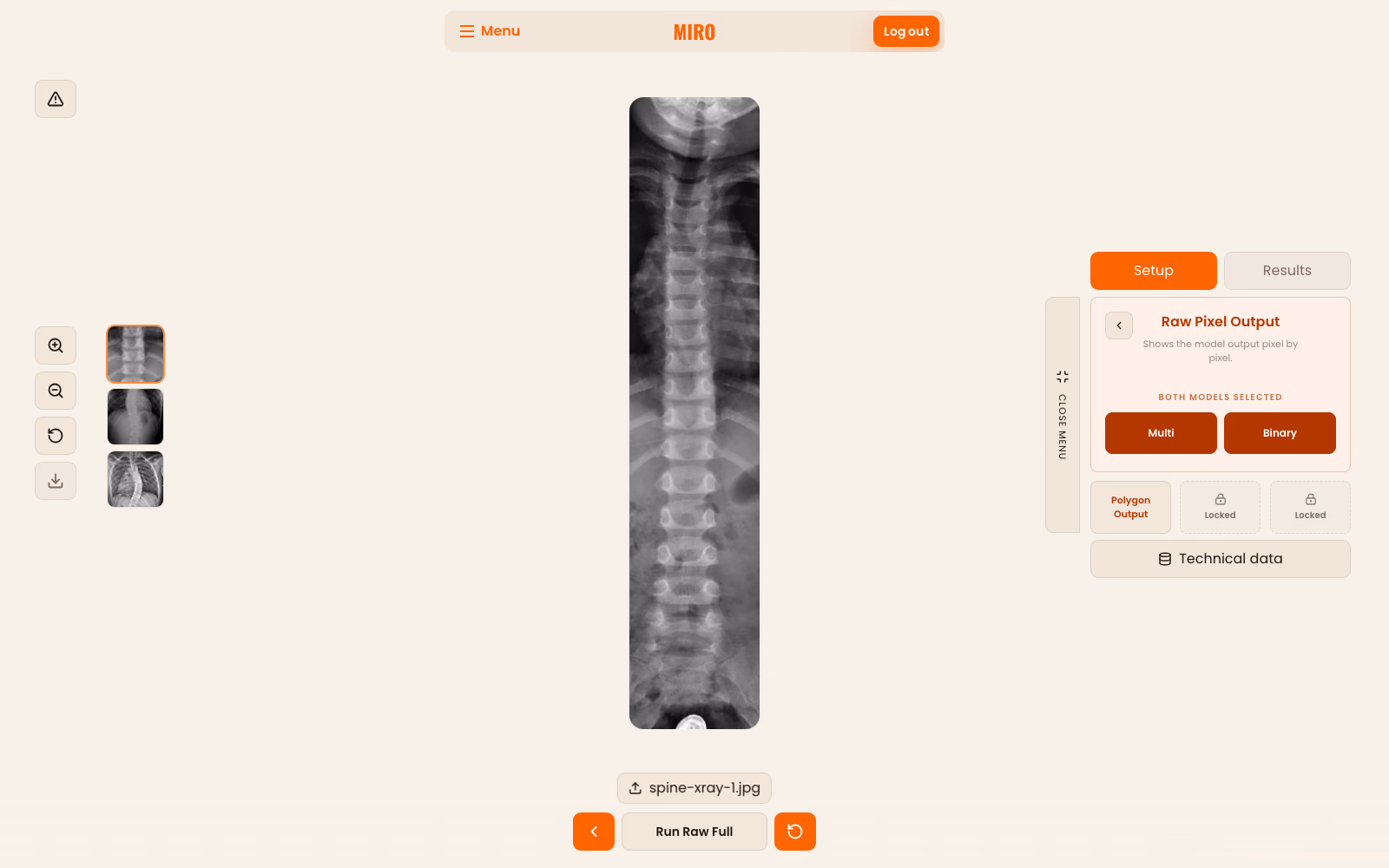 MIRO setup panel beside a demonstration spine radiograph, showing raw pixel output with multiclass and binary model options.