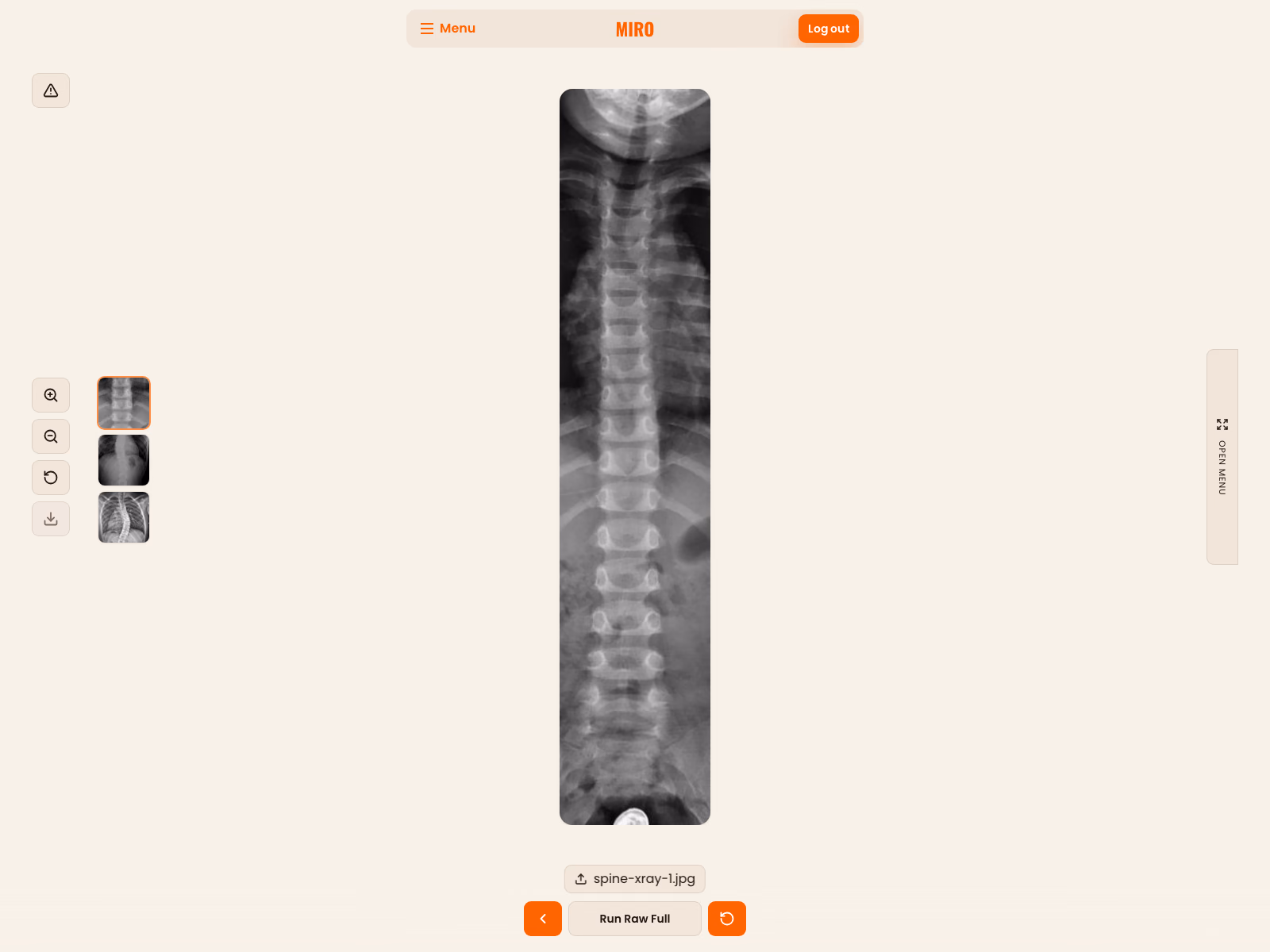 MIRO prediction workspace with a demonstration spine radiograph centered between thumbnail and zoom controls and a closed setup panel.